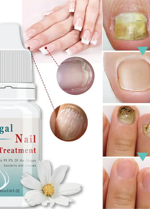 Nail Serum for Foot Care and Fungus Removal Gel