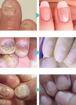 Nail Serum for Foot Care and Fungus Removal Gel